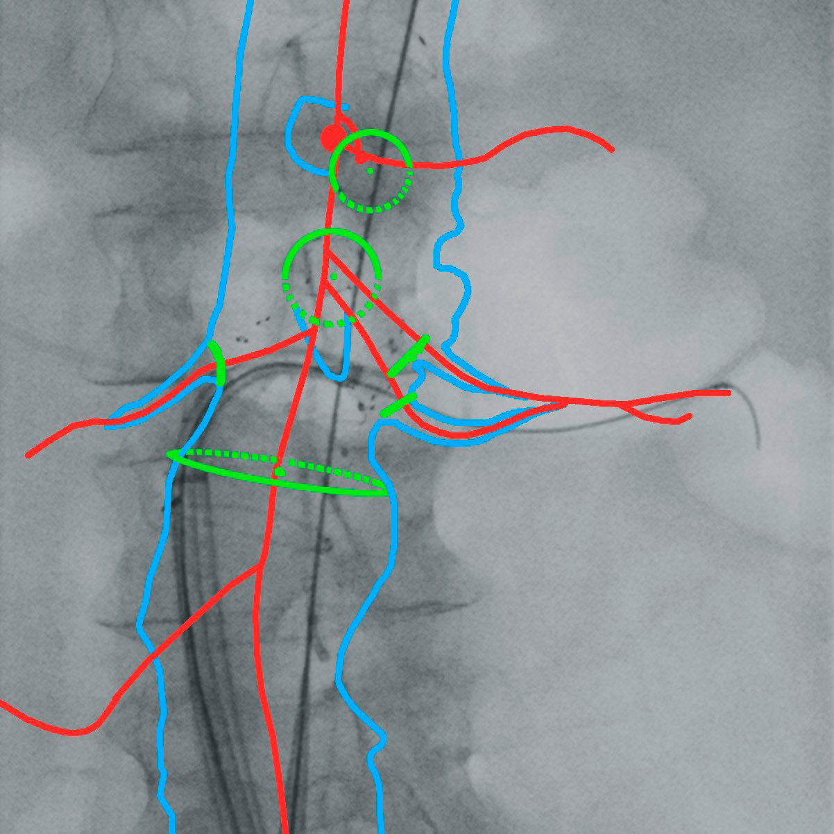 Combination of preoperative anatomy information from CT data and intraoperative live images