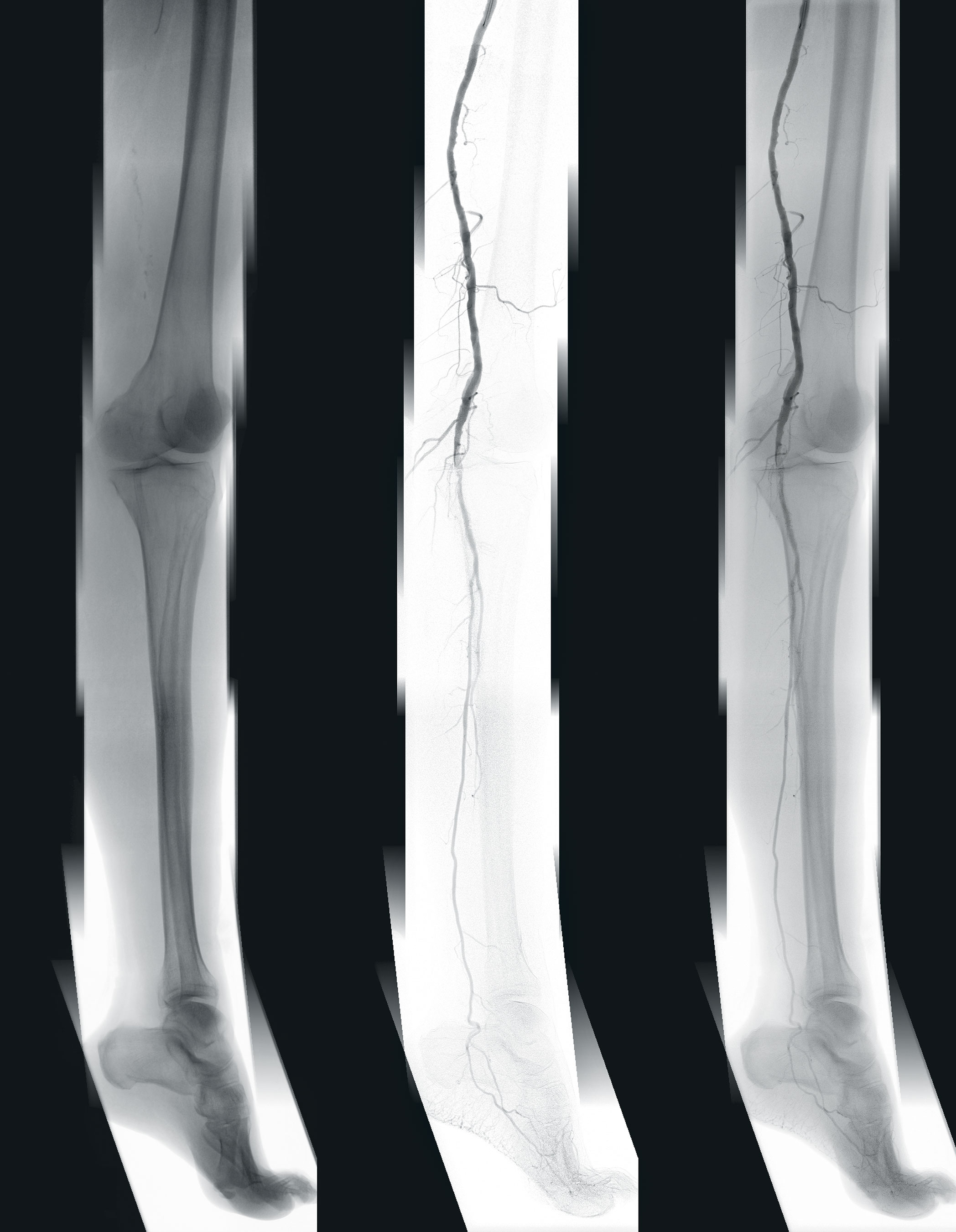 Clinical image: Pre-operative 2D fluoroscopic, angiographic, and combined fluoroscopic and angiographic panoramas