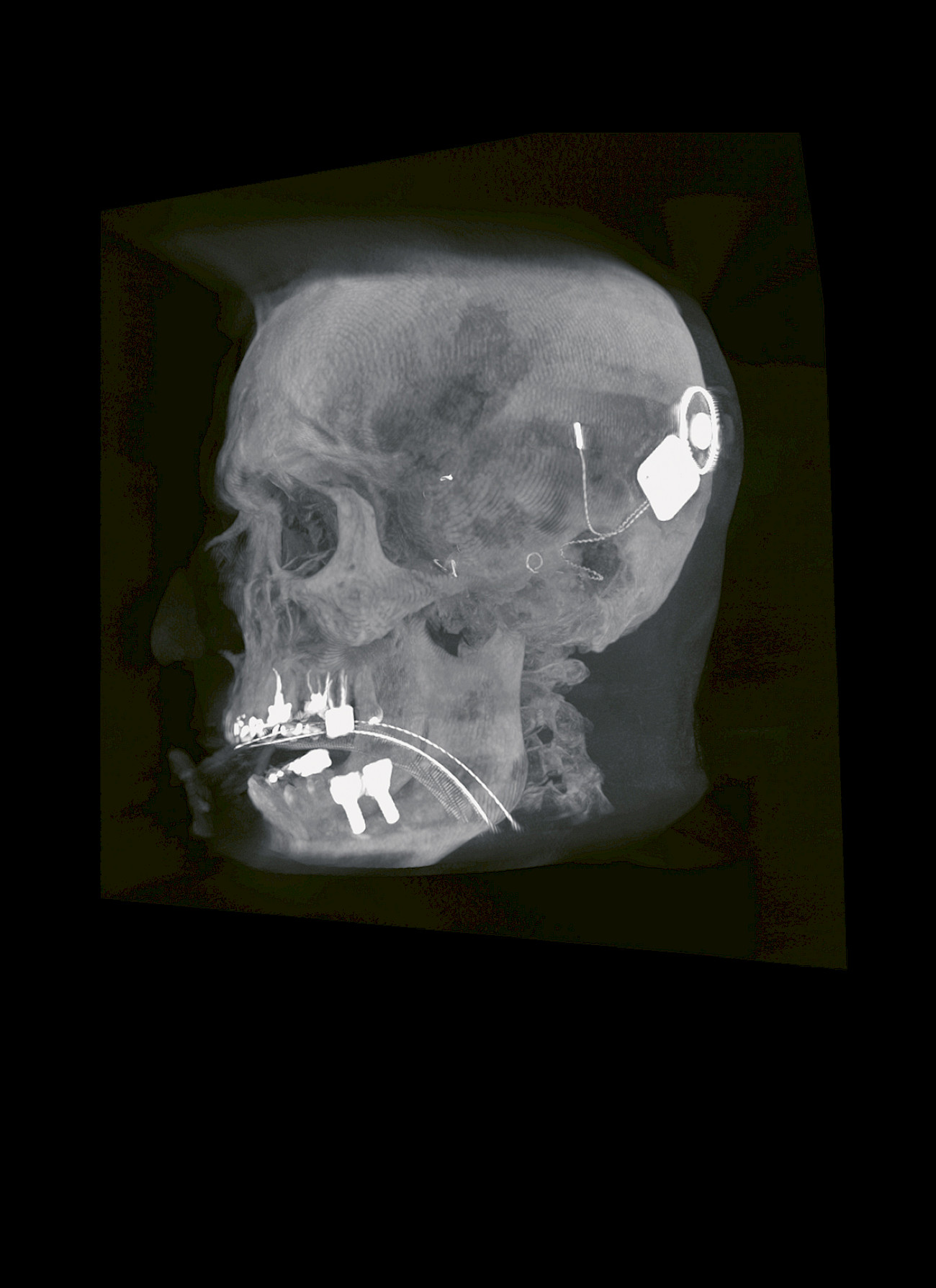 Clinical Image of a head with a cochlea implantat