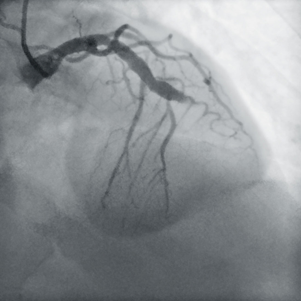 Angiography showing complete stenosis of the left main coronary artery.