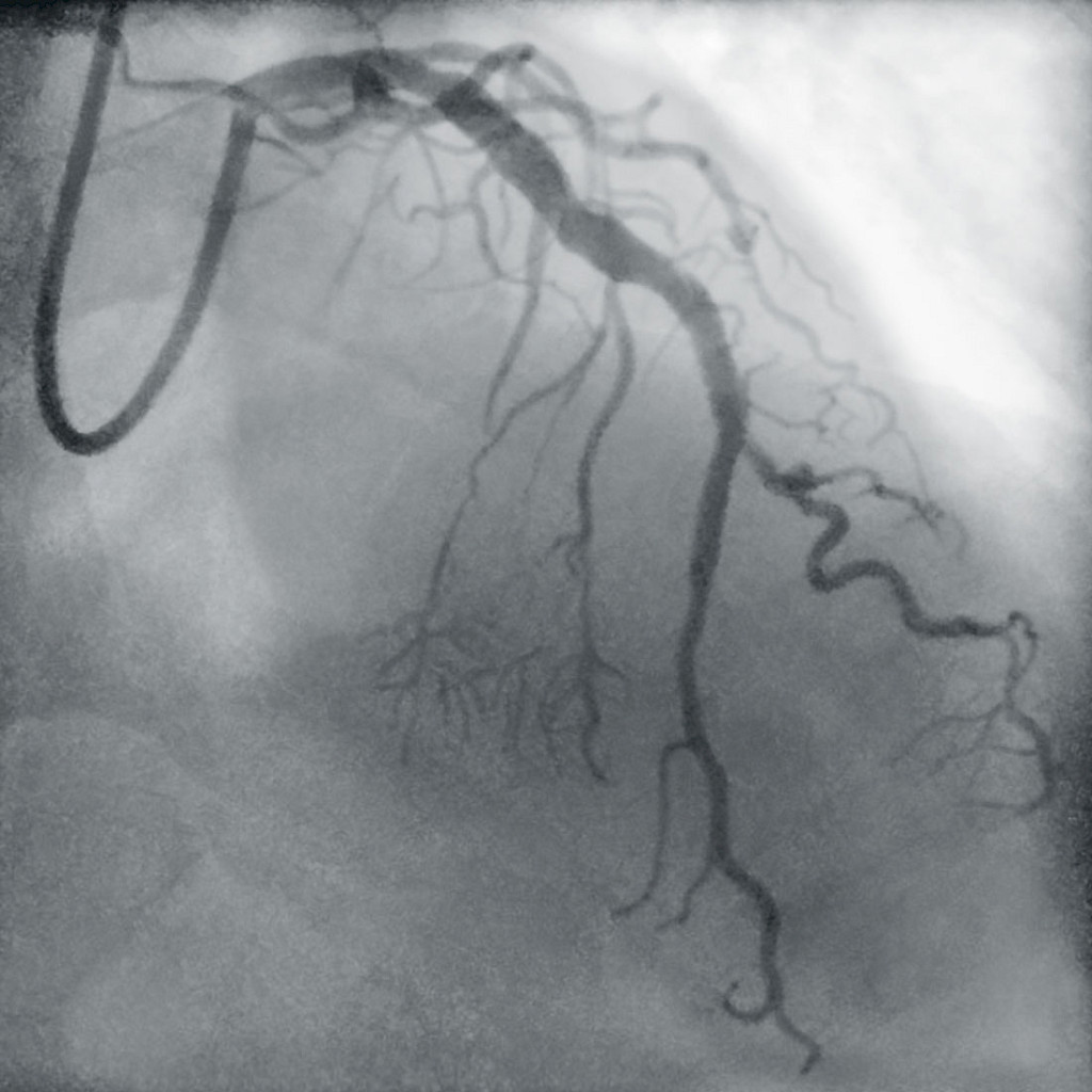 Angiographiy showing successful revascularization of complete main artery stenosis.