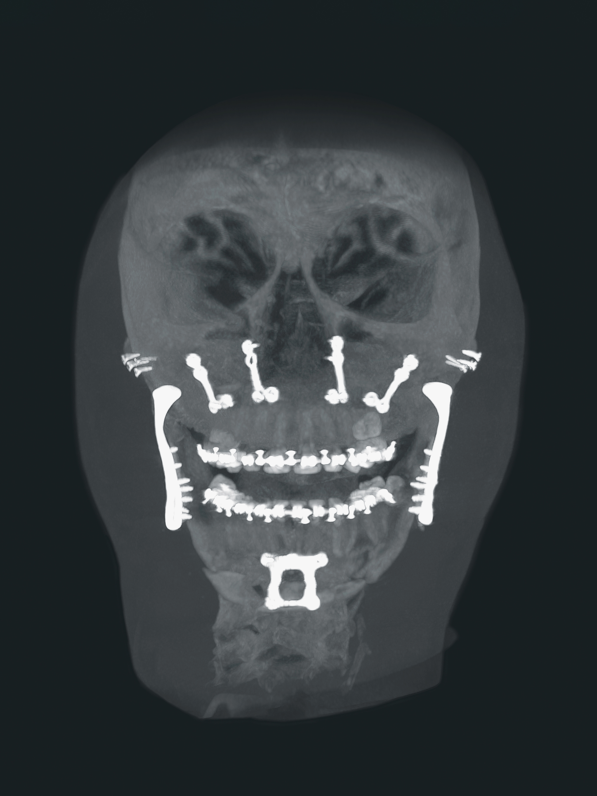 Clinical image showing a juvenile arthritis, acquired at TAYS University Hospital, Tampere, Finland, by Dr. Aimo Miettinen