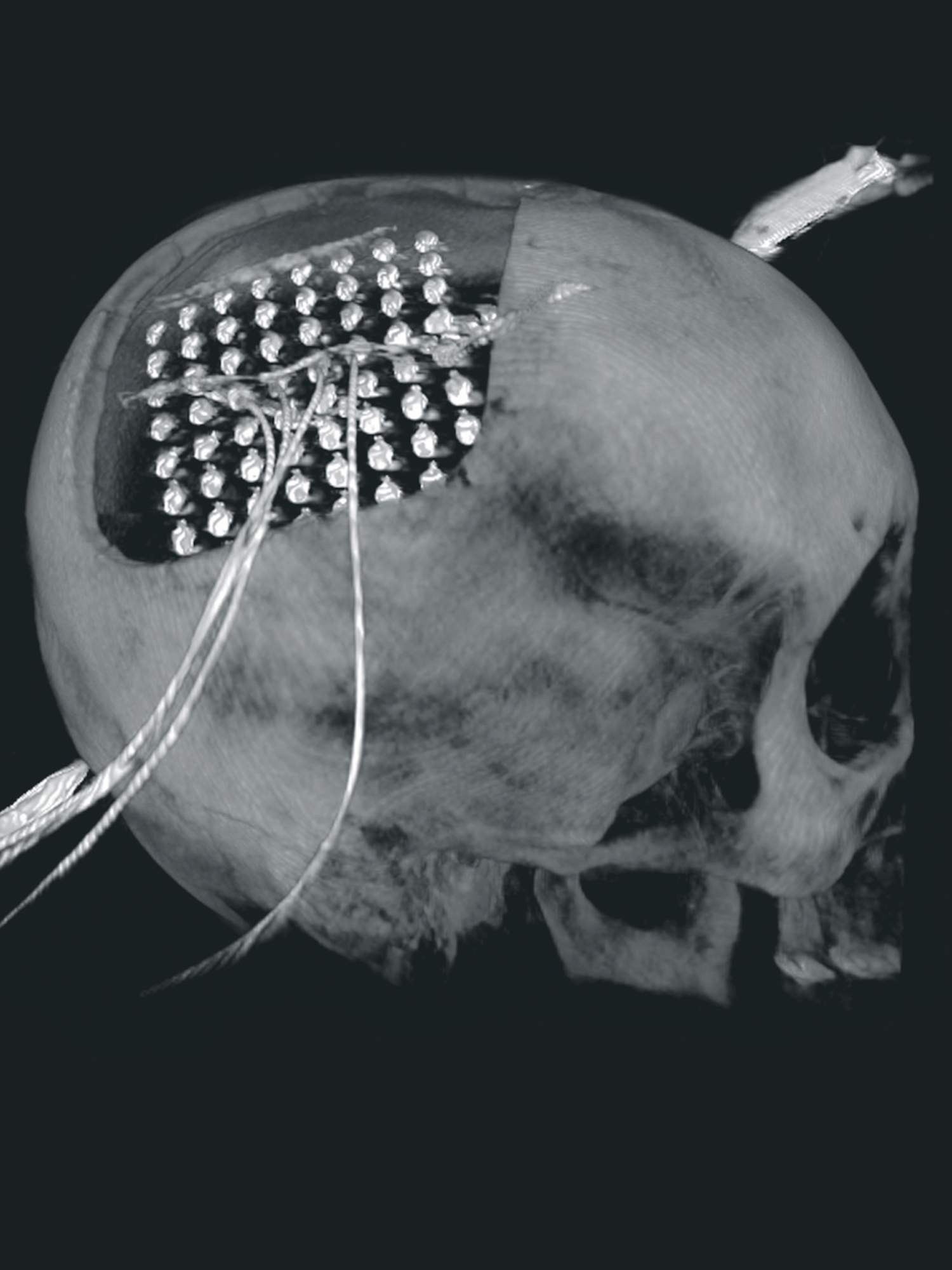 Clinical images of a head with a subdural electrode implant.