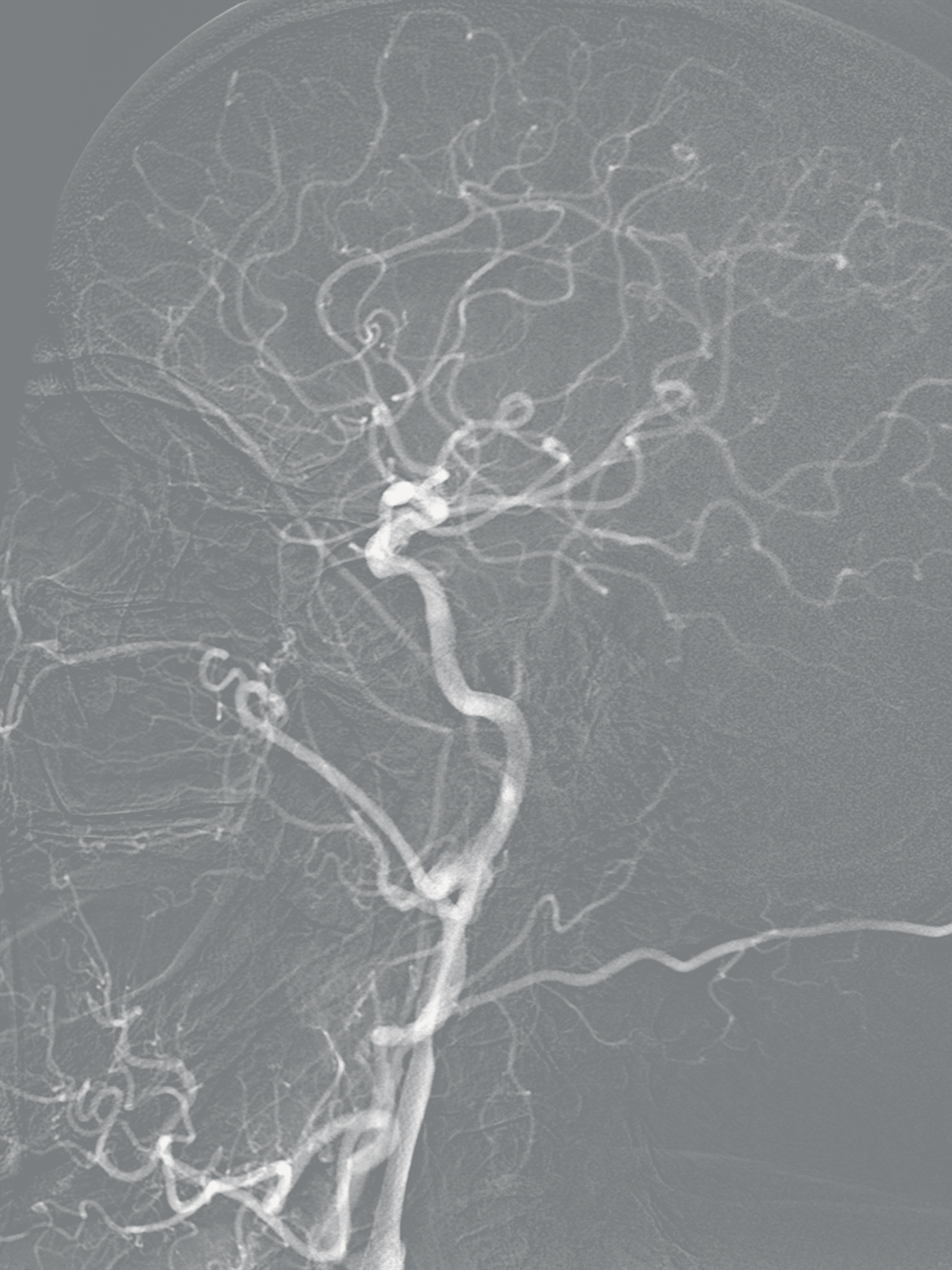 Roadmapping Subtraction Angiography (RSA), acquired at the Medical University of Lublin, Poland.