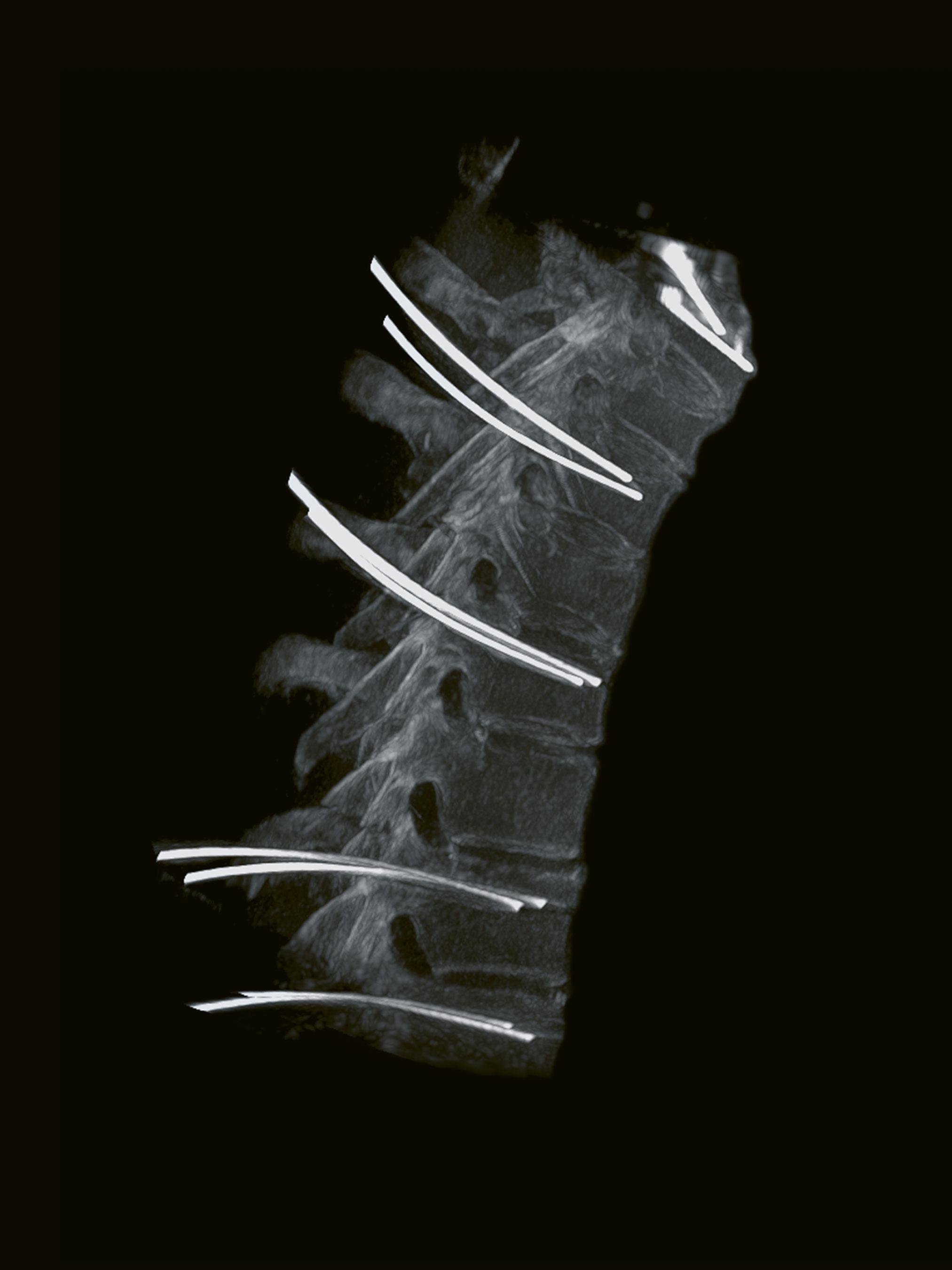 Clinical image spine surgery