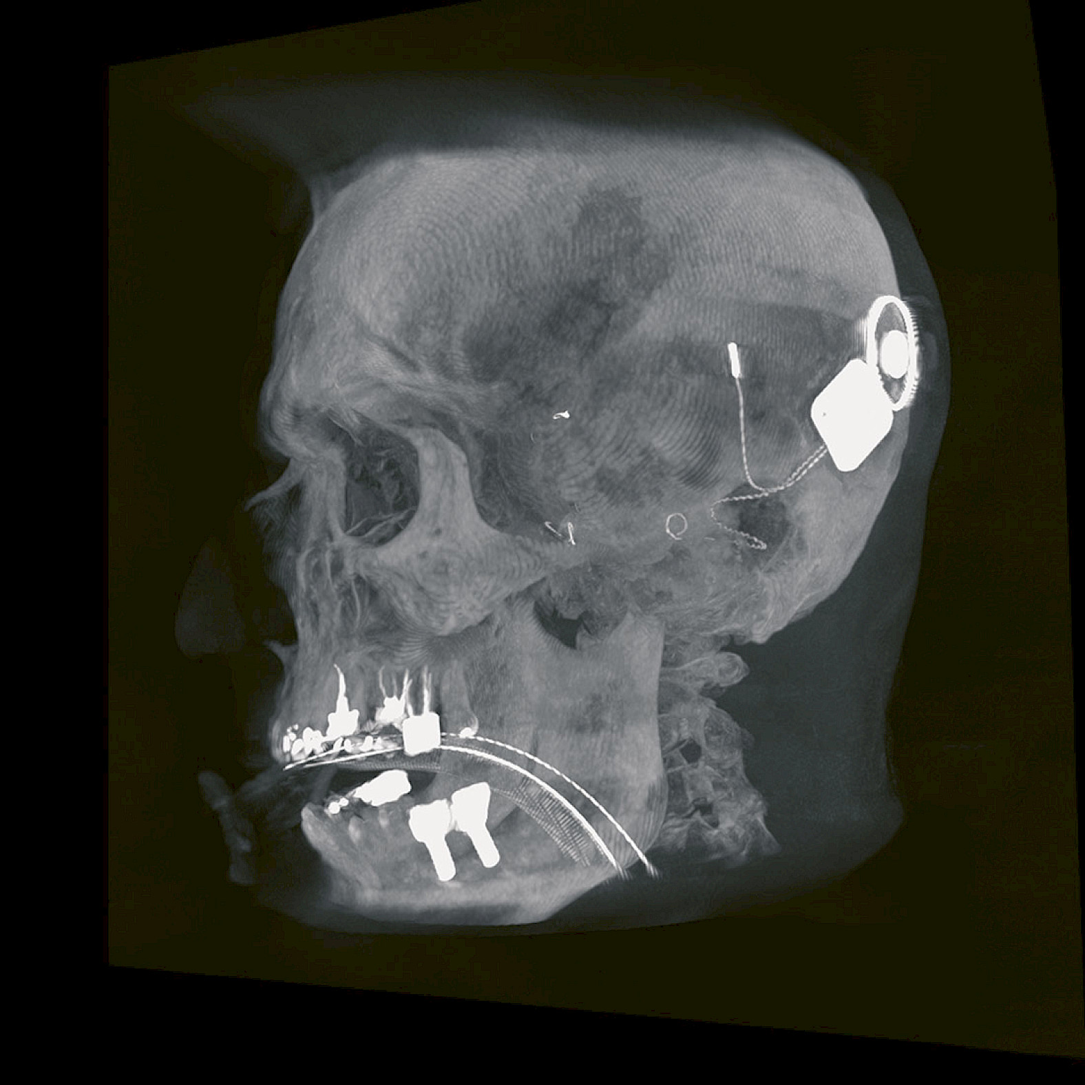Clinical head image with cochlear implant