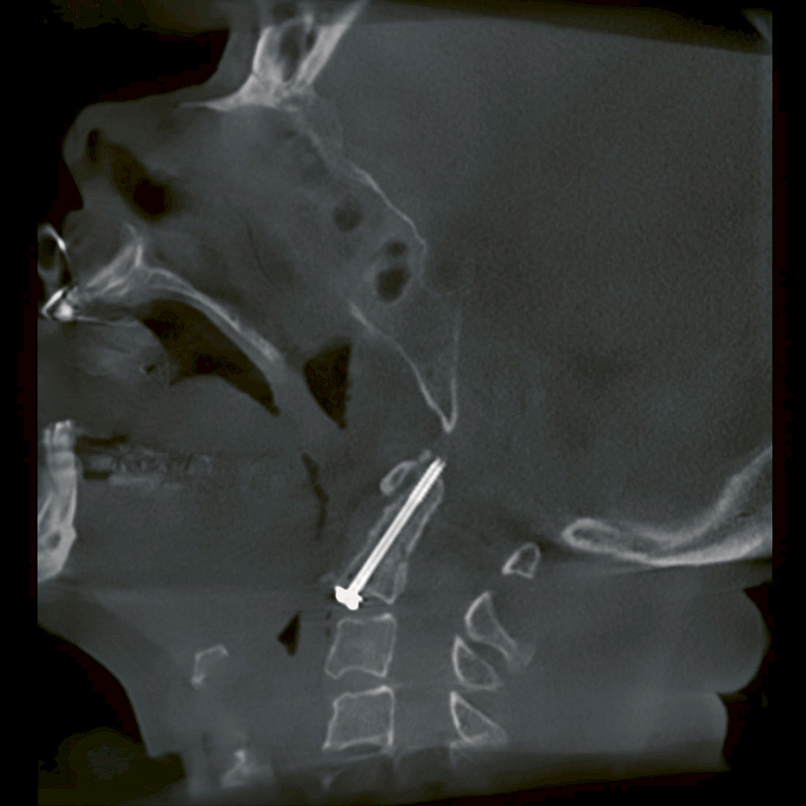 Cinical image spine surgery (Prof. Josten)