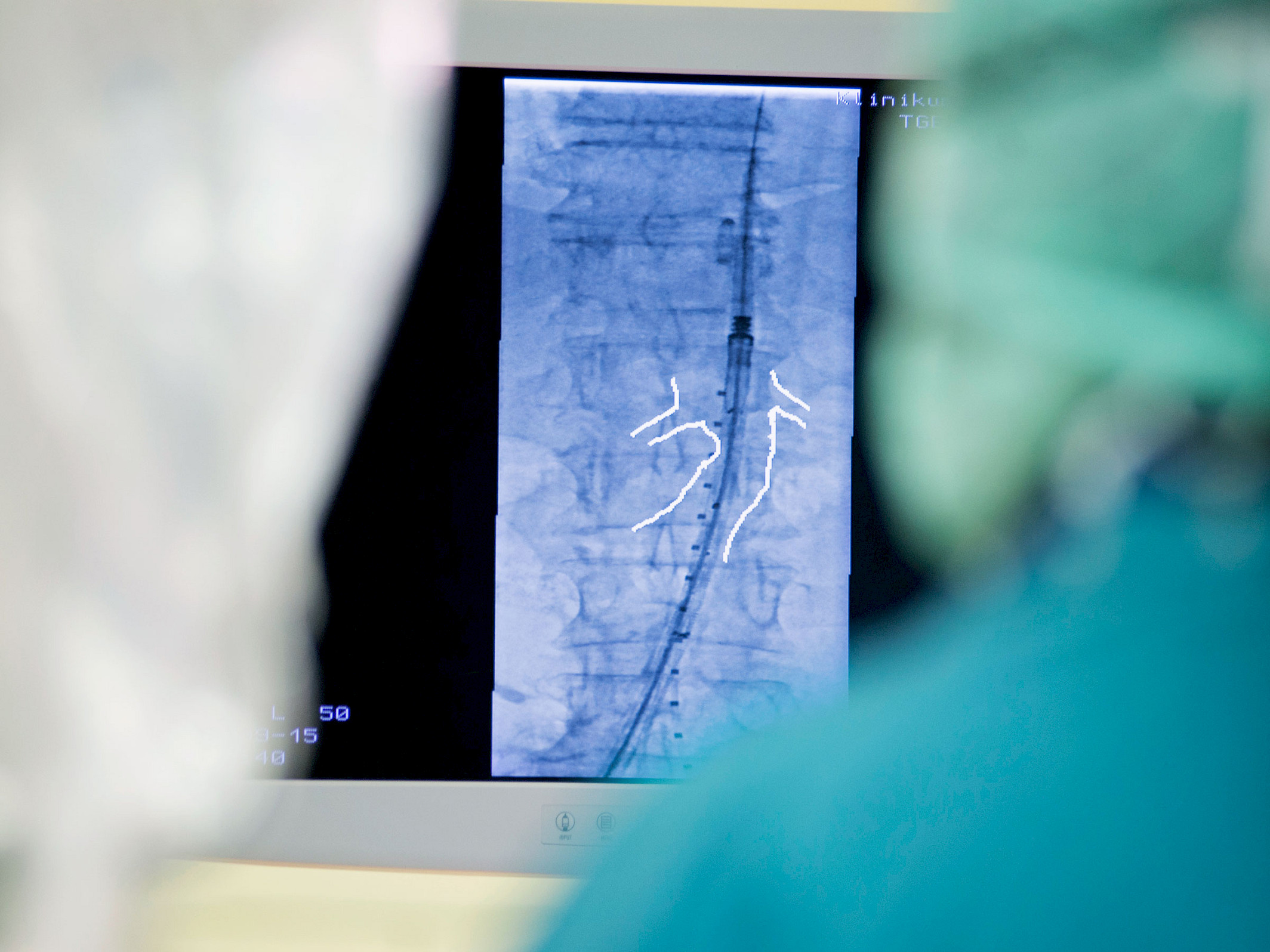 Overshoulder view on a screen: The surgeon marks the course of the internal iliac artery on the screen using an anatomical marking tool.
