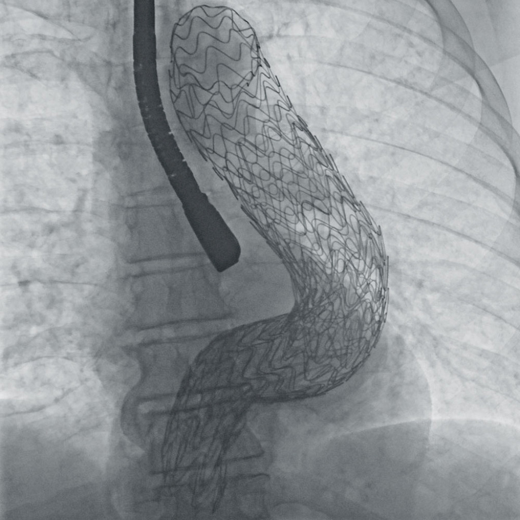 Clinical image: 2D view of a stent after opening