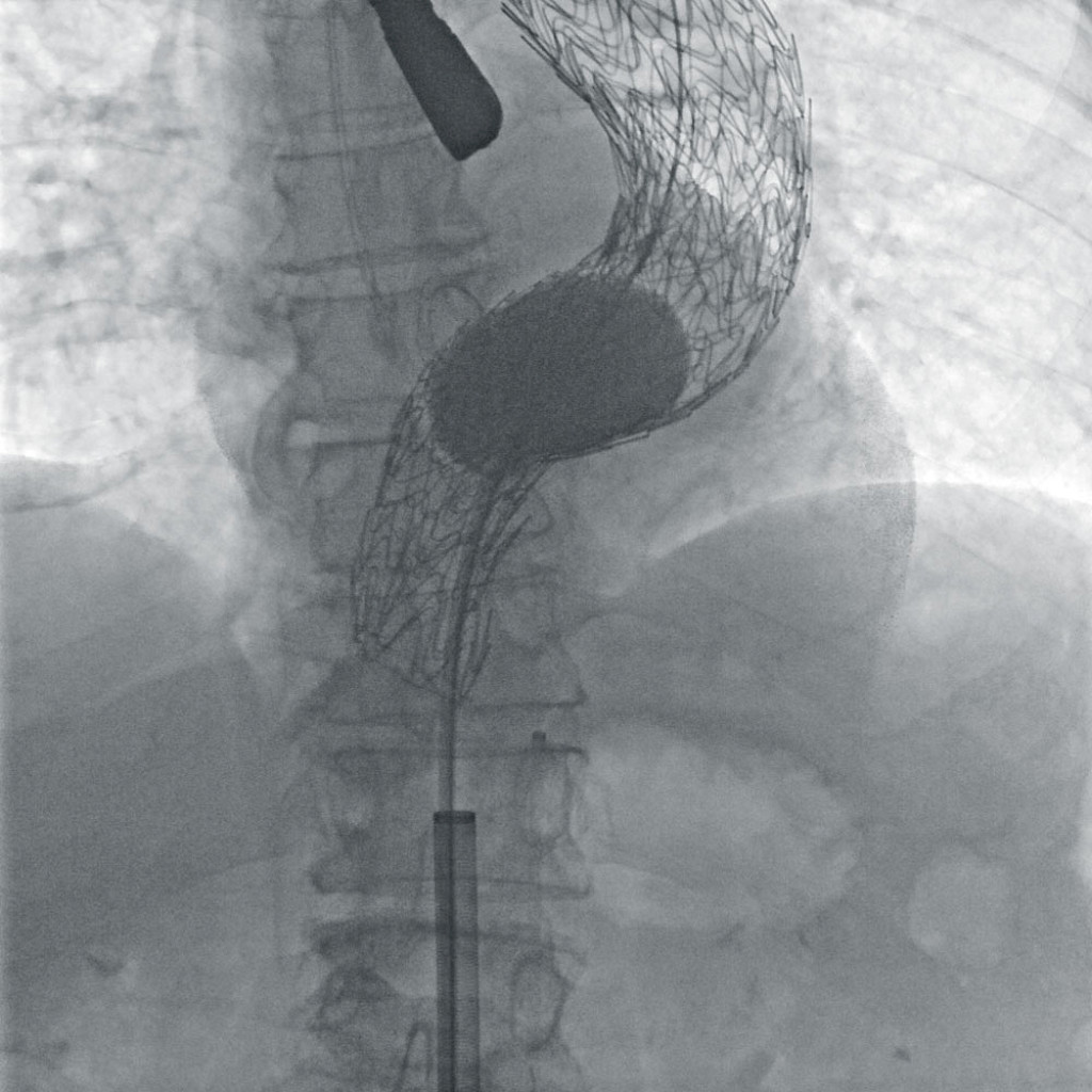 Clincal image of 2D stent after dilatation