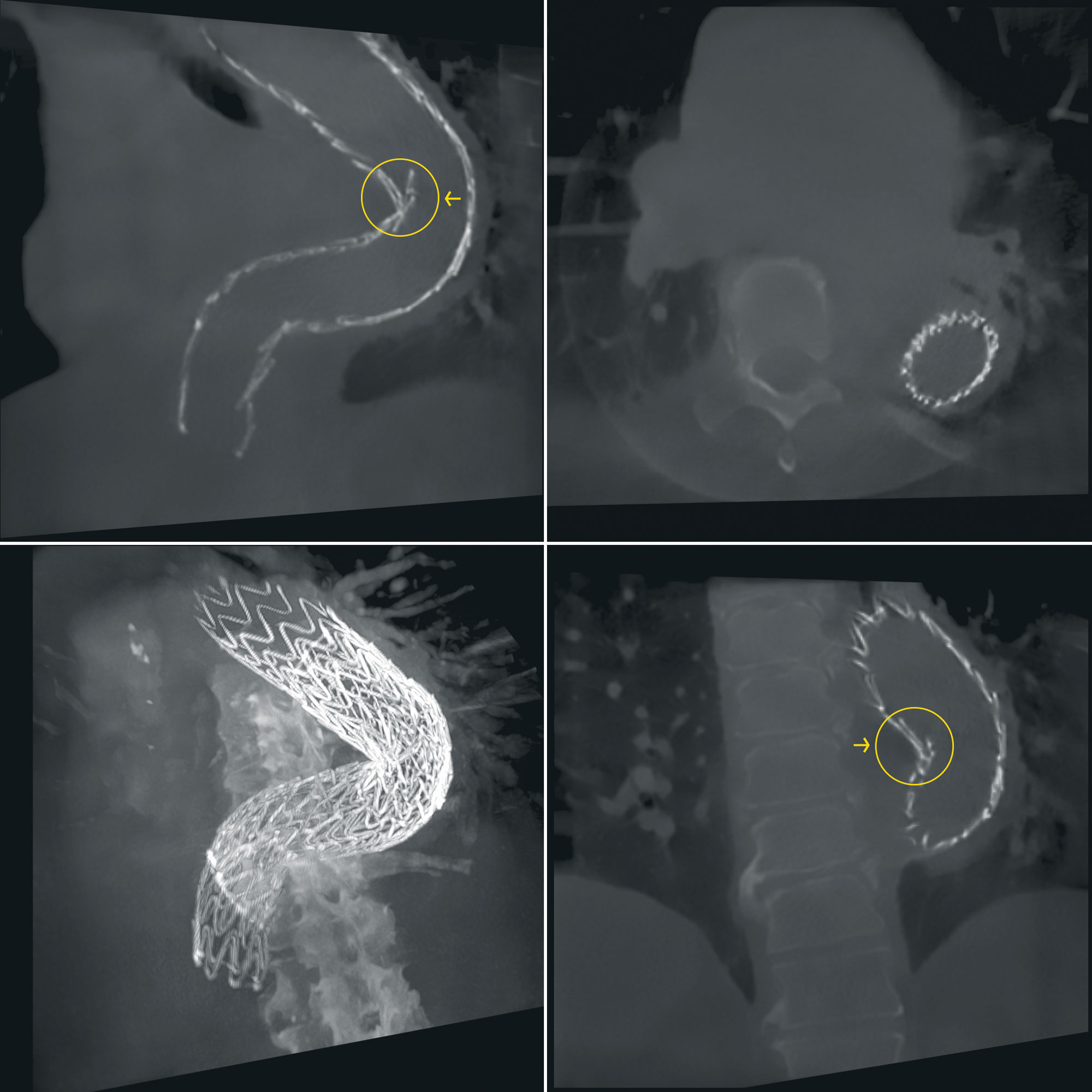 4 clinical images showing 3D control images during a stent procedure