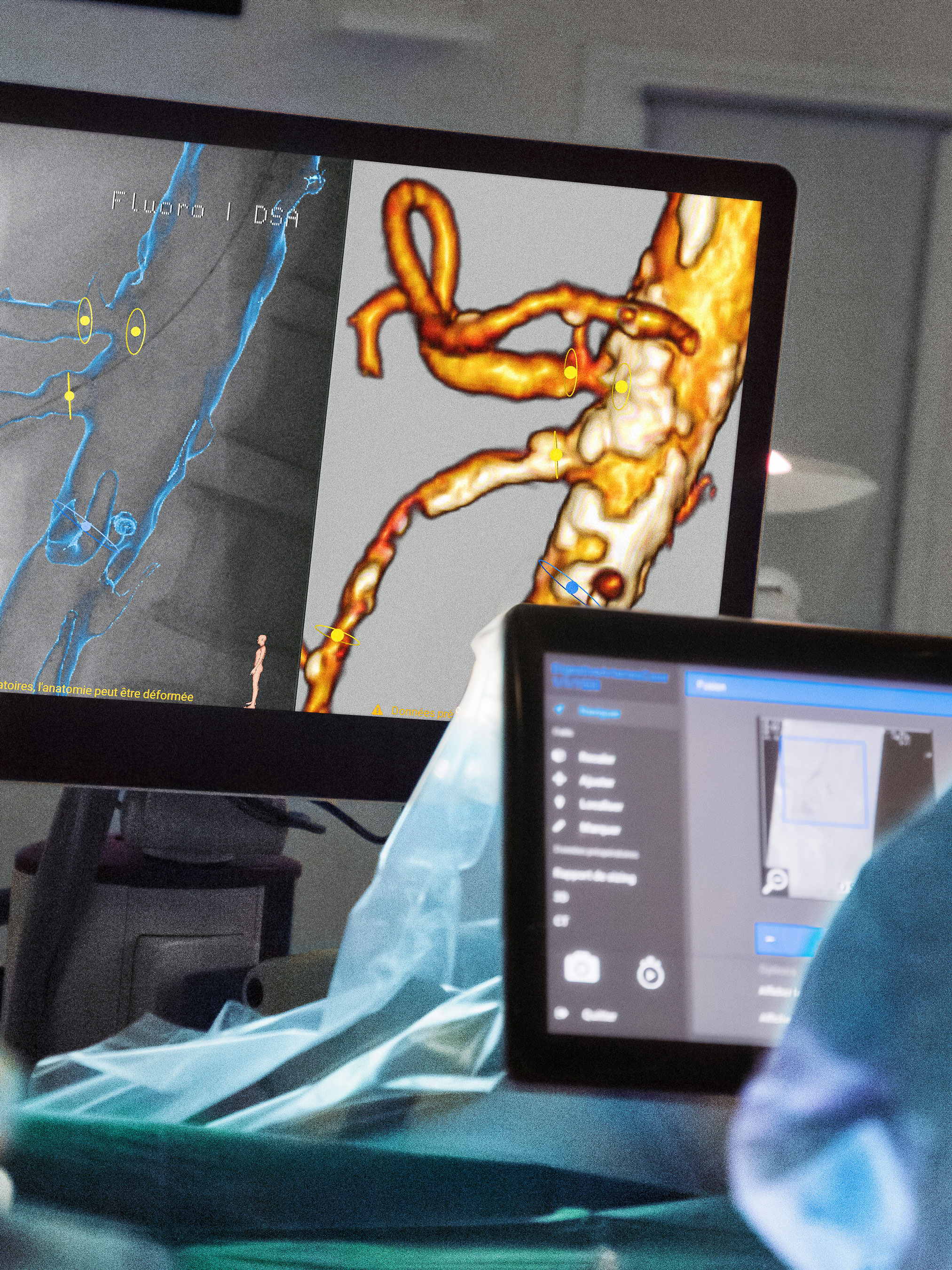 Two monitors in an operating room: one shows the overlay of pre-processed CT images with live C-arm images; the other shows a user interface for setting scan parameters.