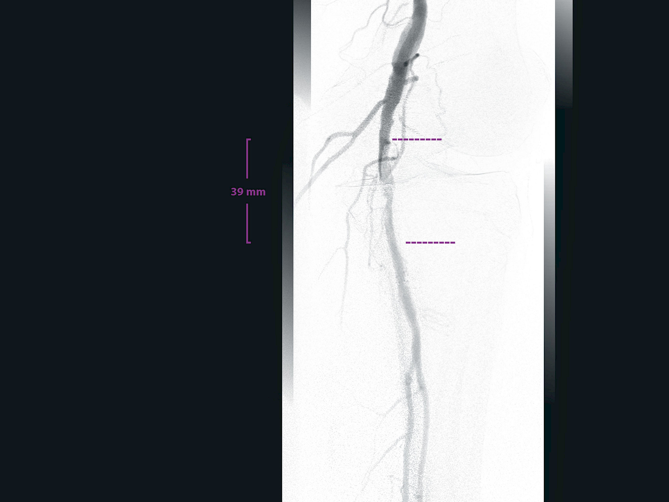 Clincal image of angiographic panorama showing localization, marking and measuring of a lesion