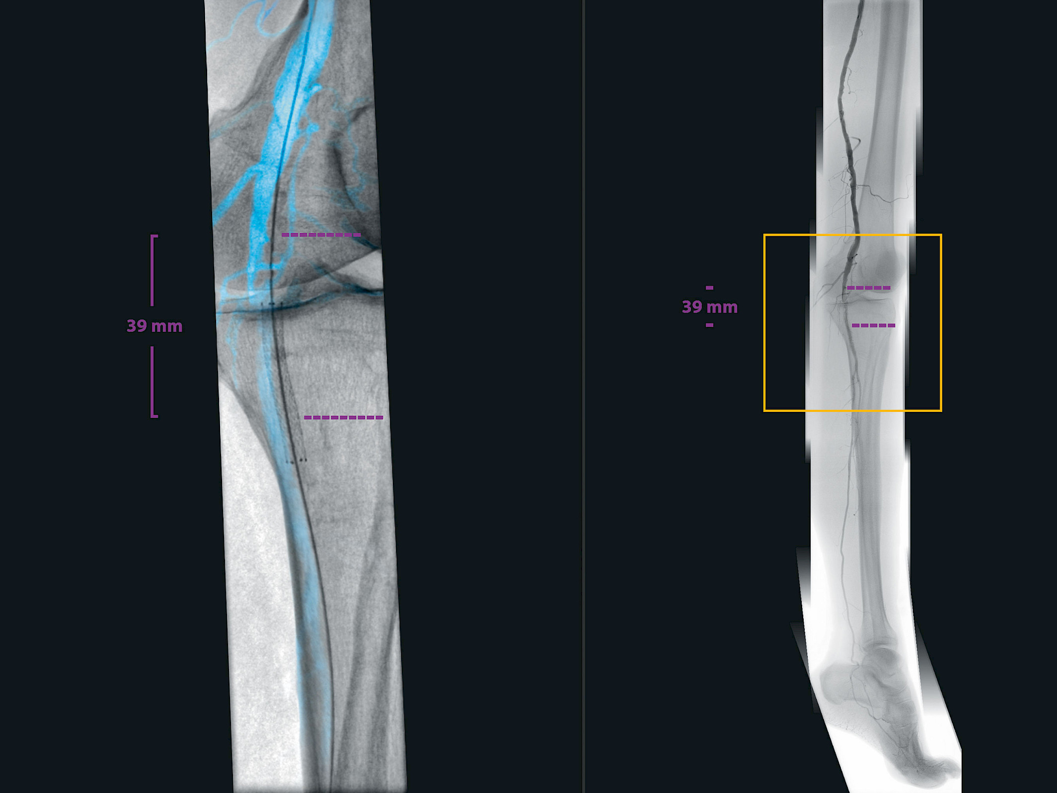 Clinical image showing image fusion and guidewire insertion