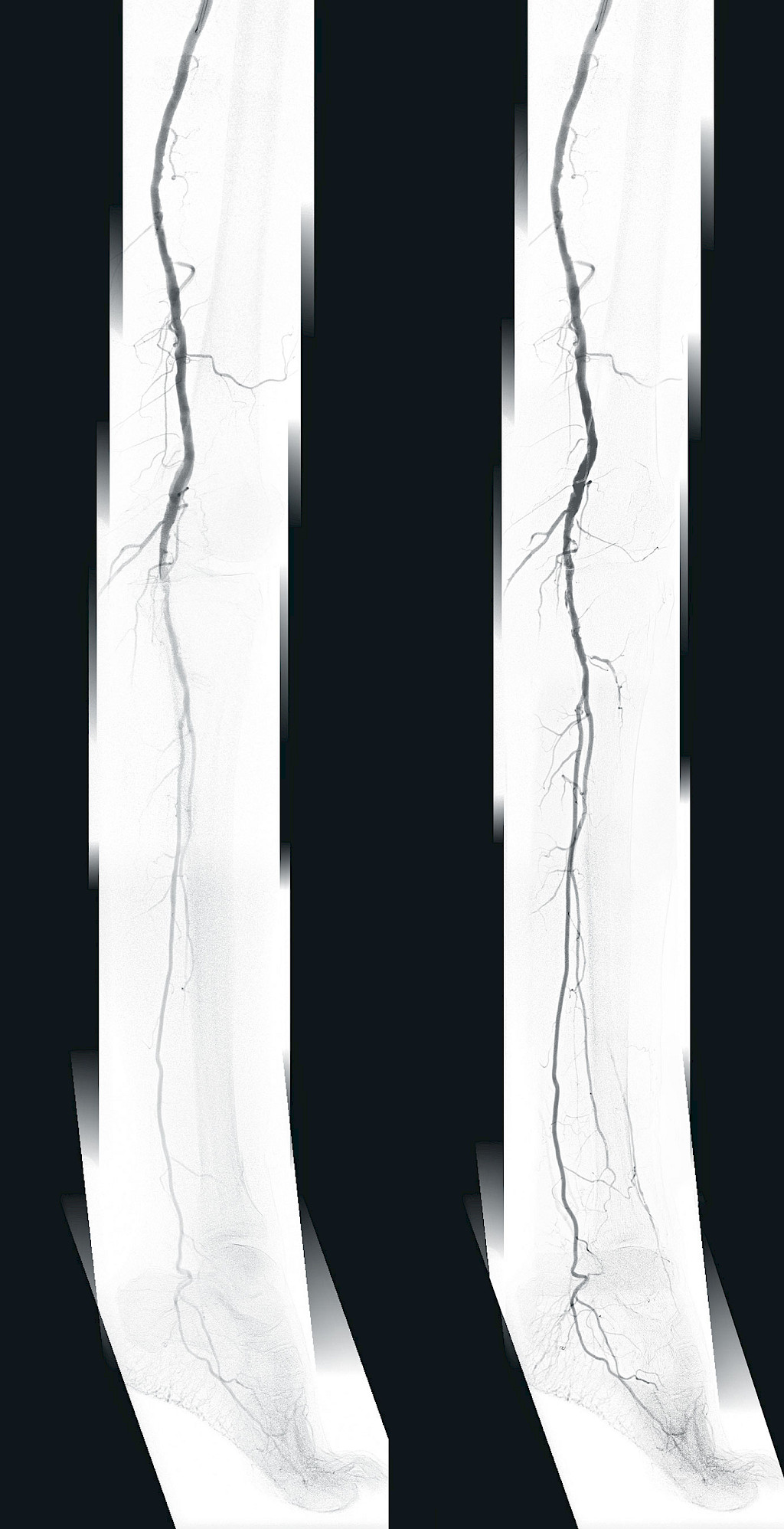 Clinical image showing comparison of preoperative panorama and control panorama after 24-hour lysis