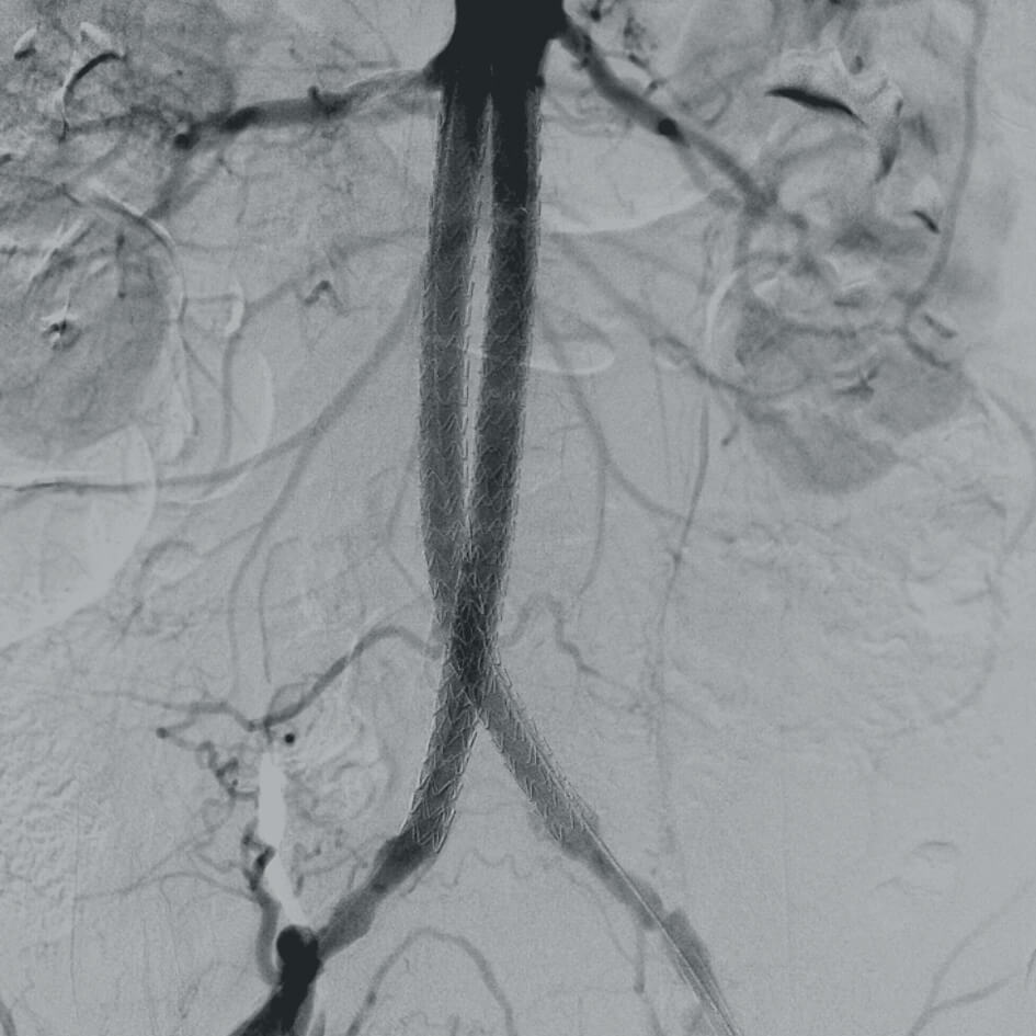 Vascular surgery