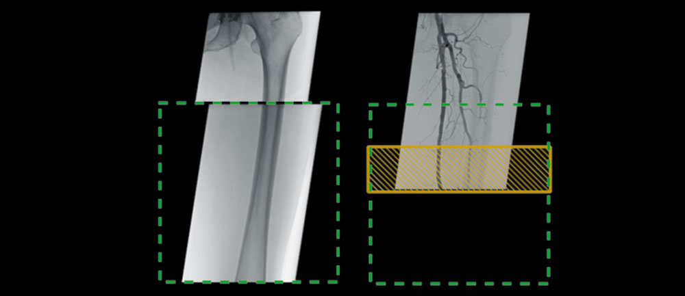 Endovascular Navigation Peripheral