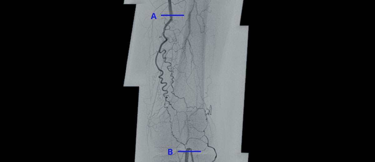 Endovascular Navigation Peripheral
