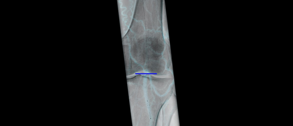 Endovascular Navigation Peripheral