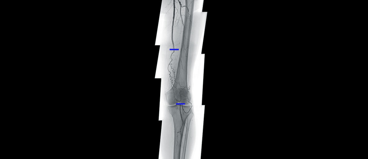 Endovascular Navigation Peripheral