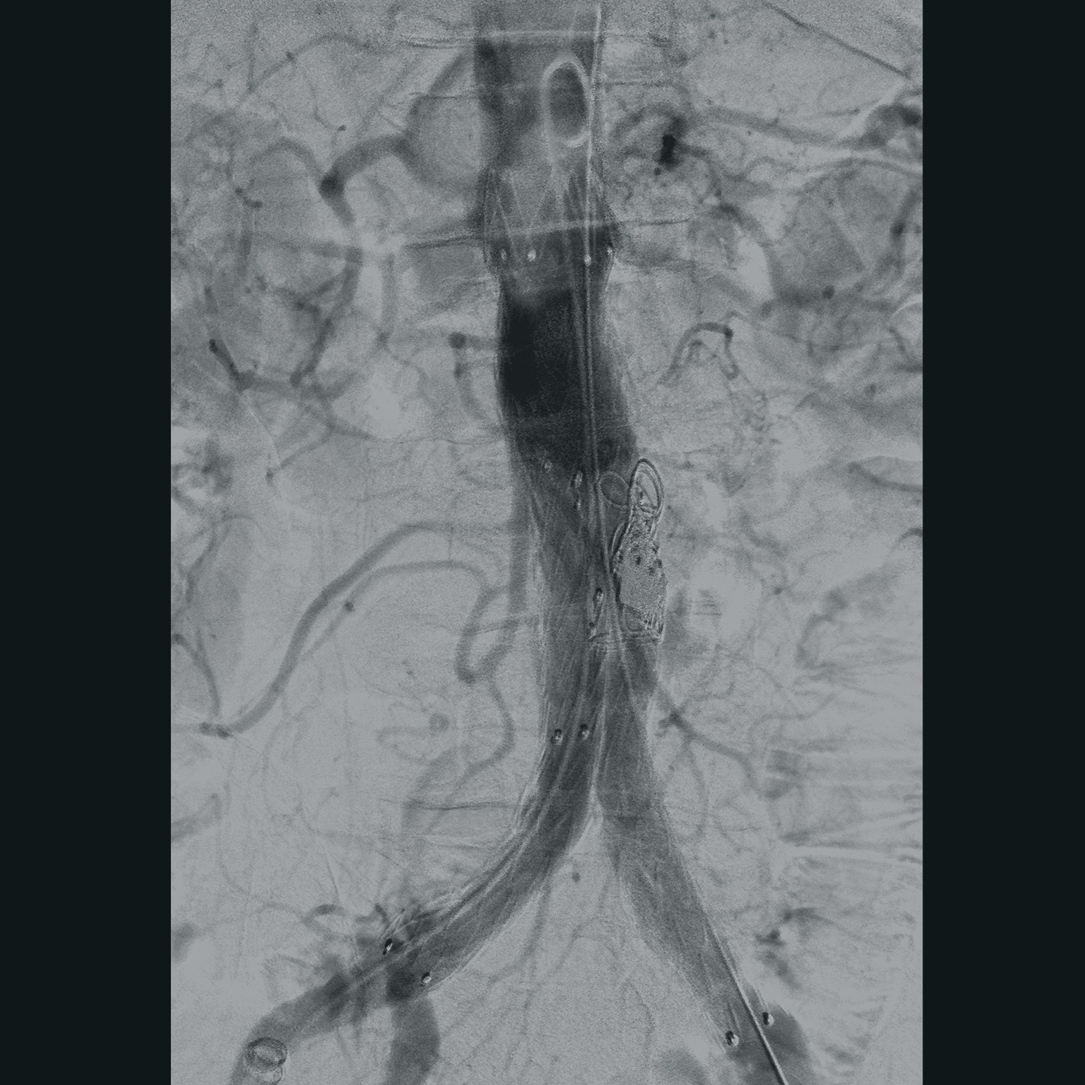 Vascular surgery