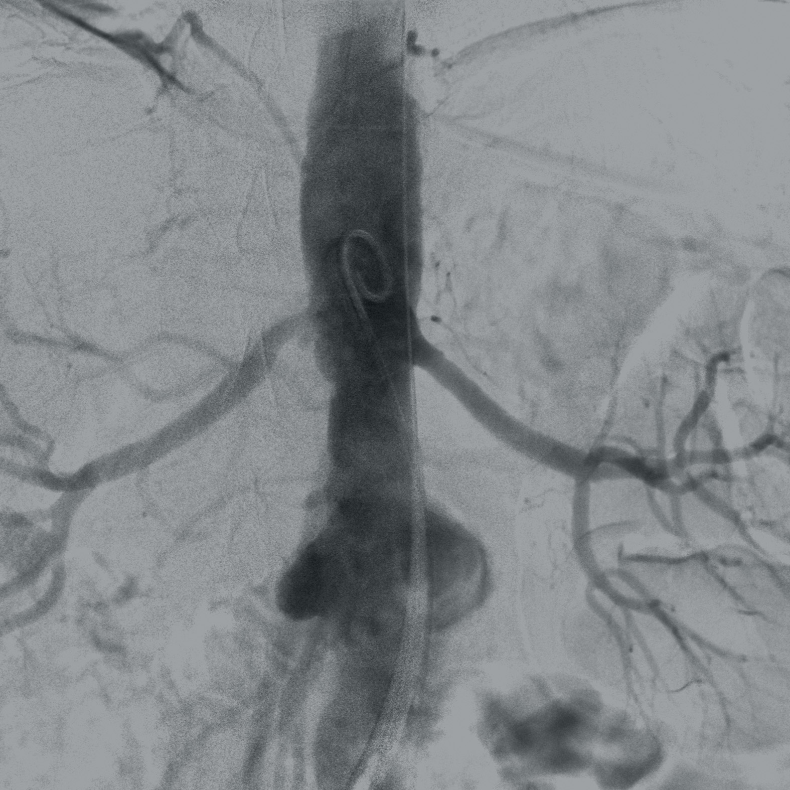 Vascular surgery