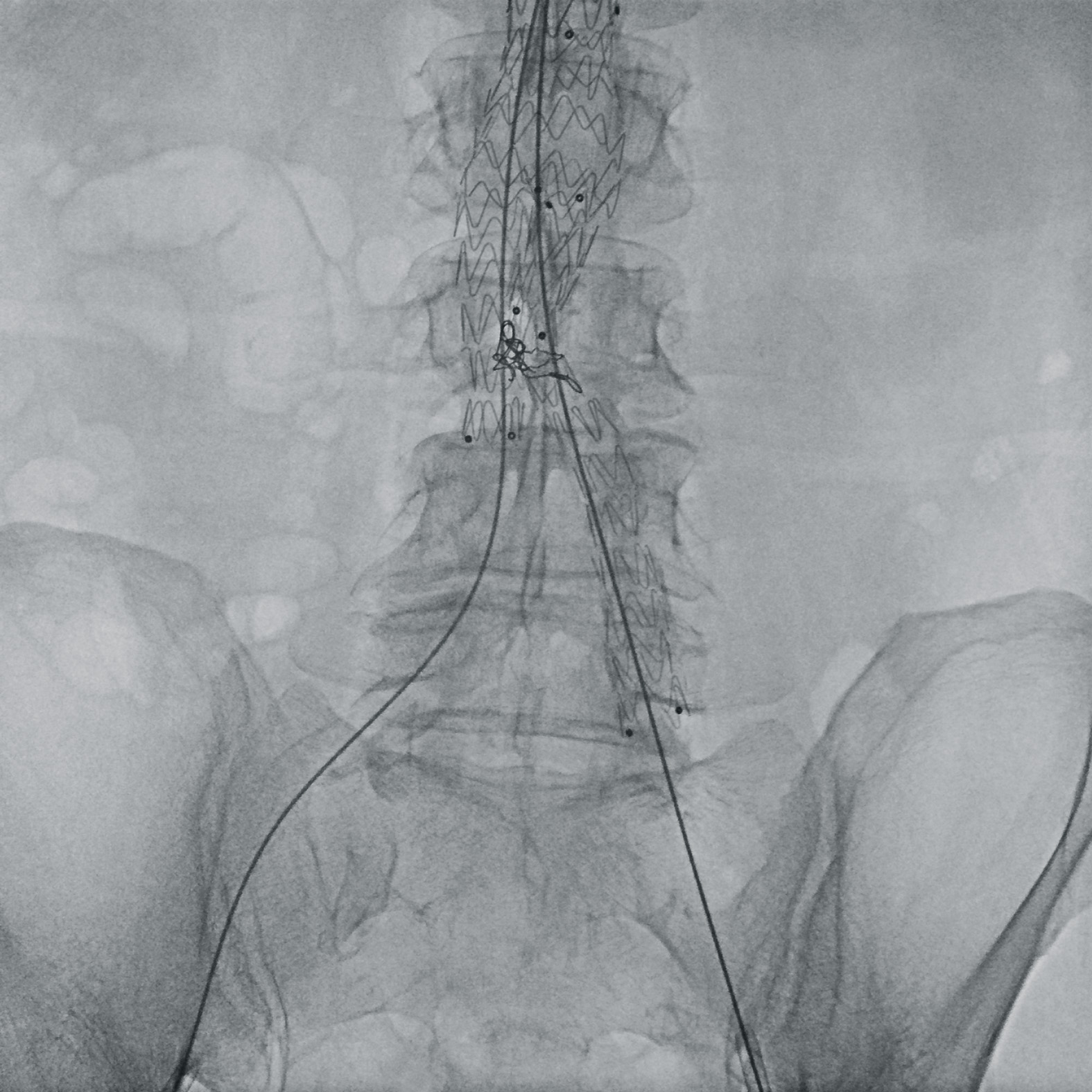 Vascular surgery