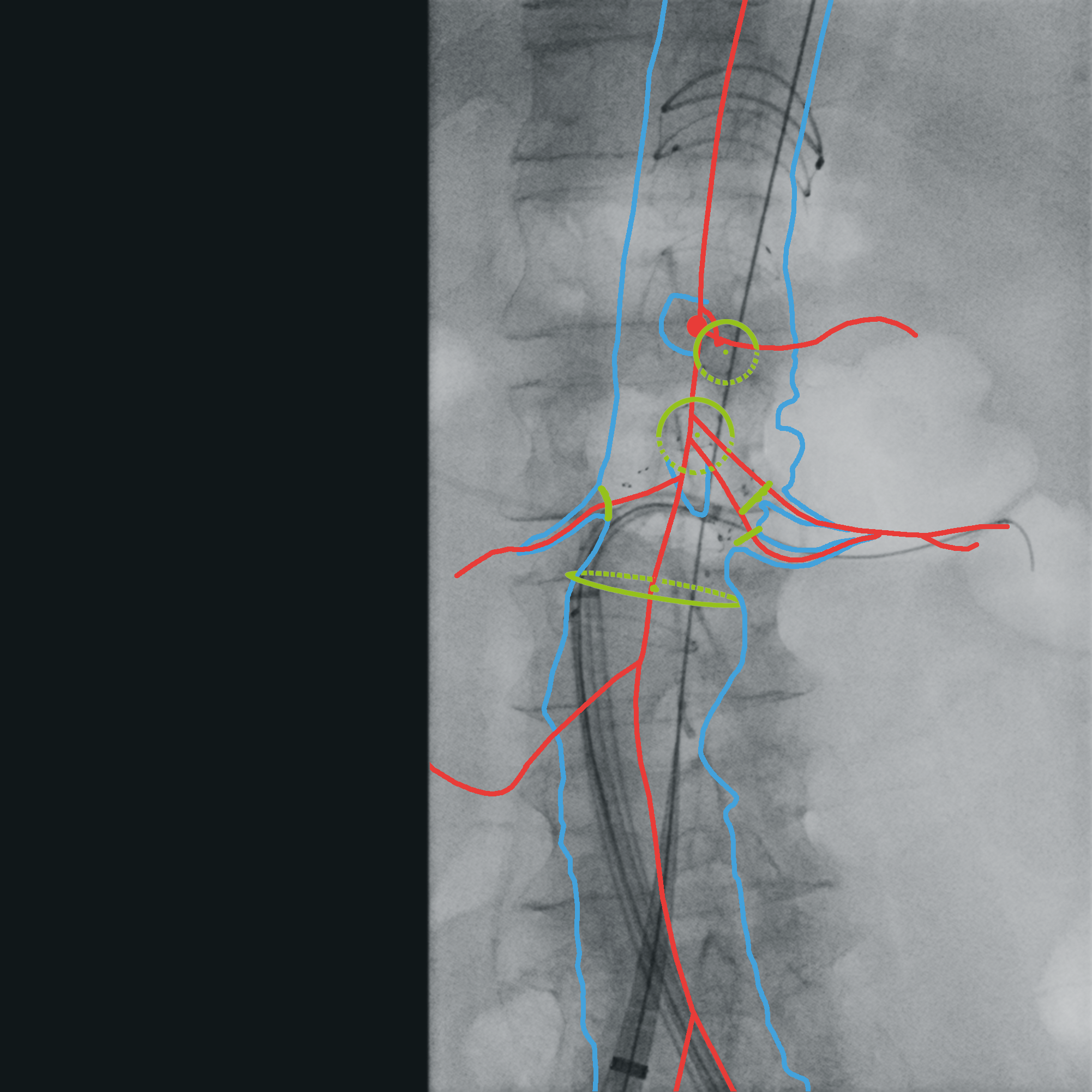 Vascular surgery