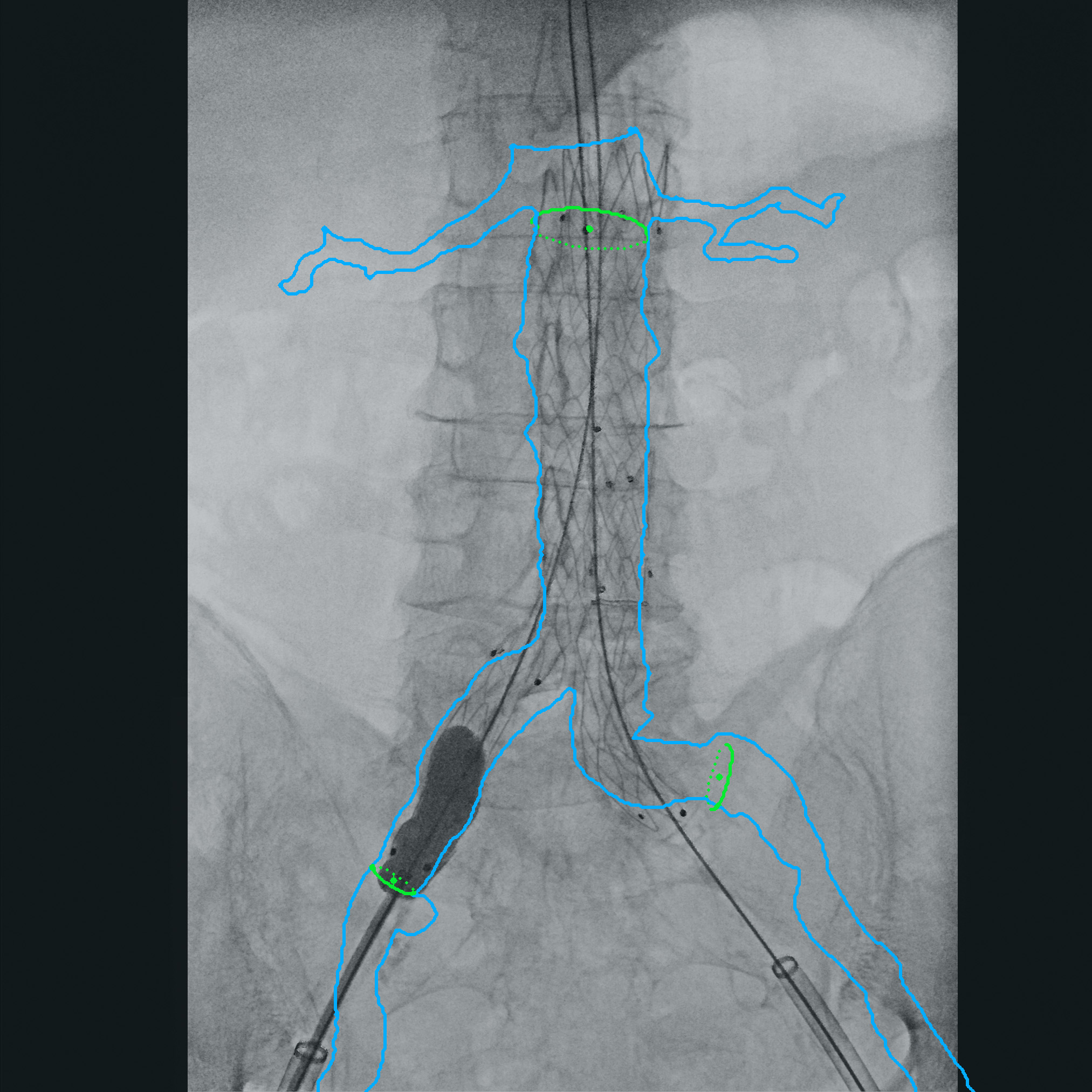 Vascular surgery