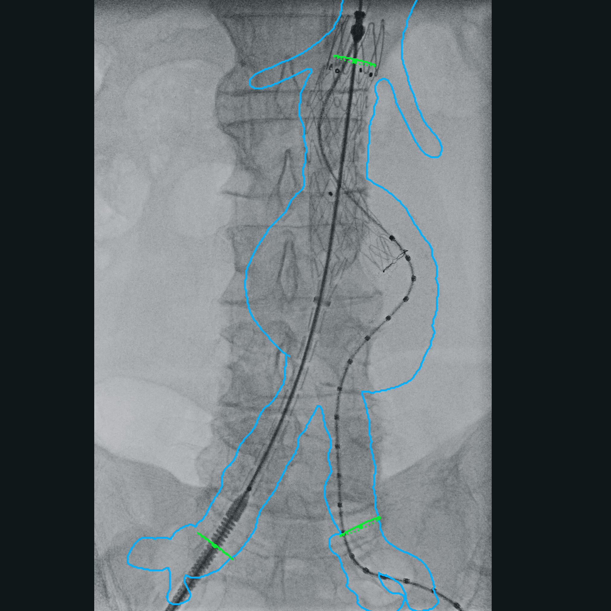 Vascular surgery