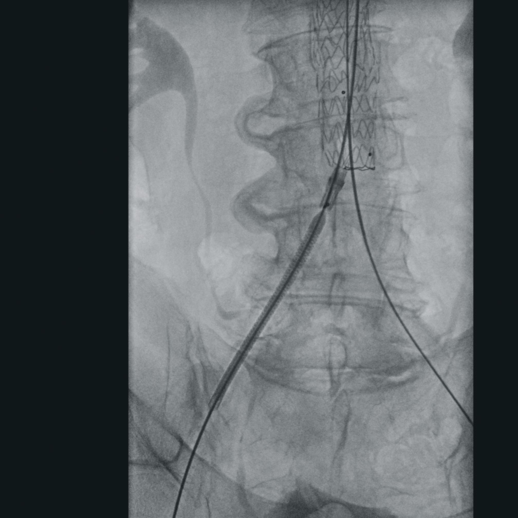 Vascular surgery