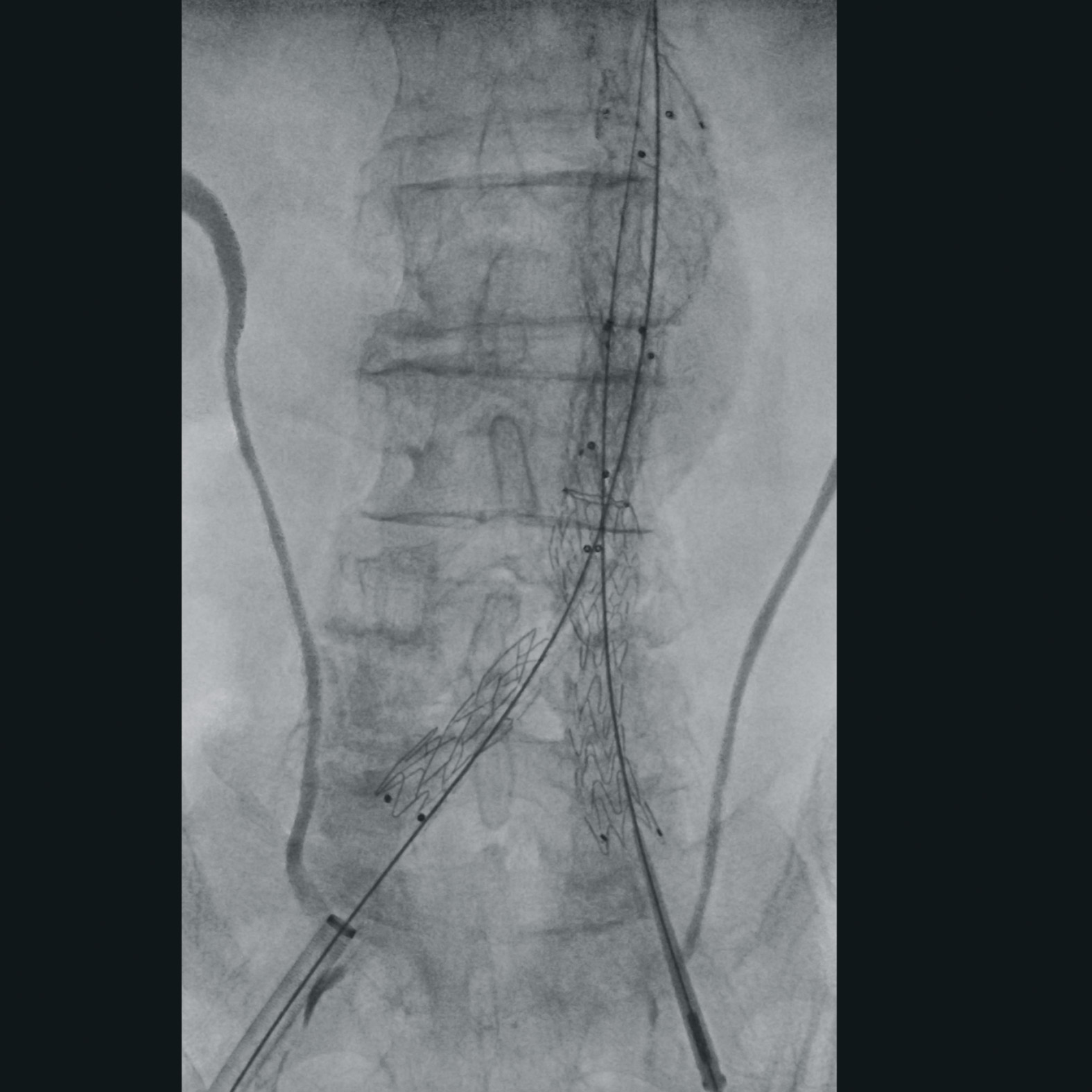 Vascular surgery
