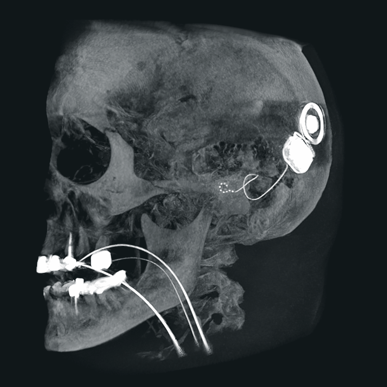 Cochlea-Implantation und HNO-Chirurgie
