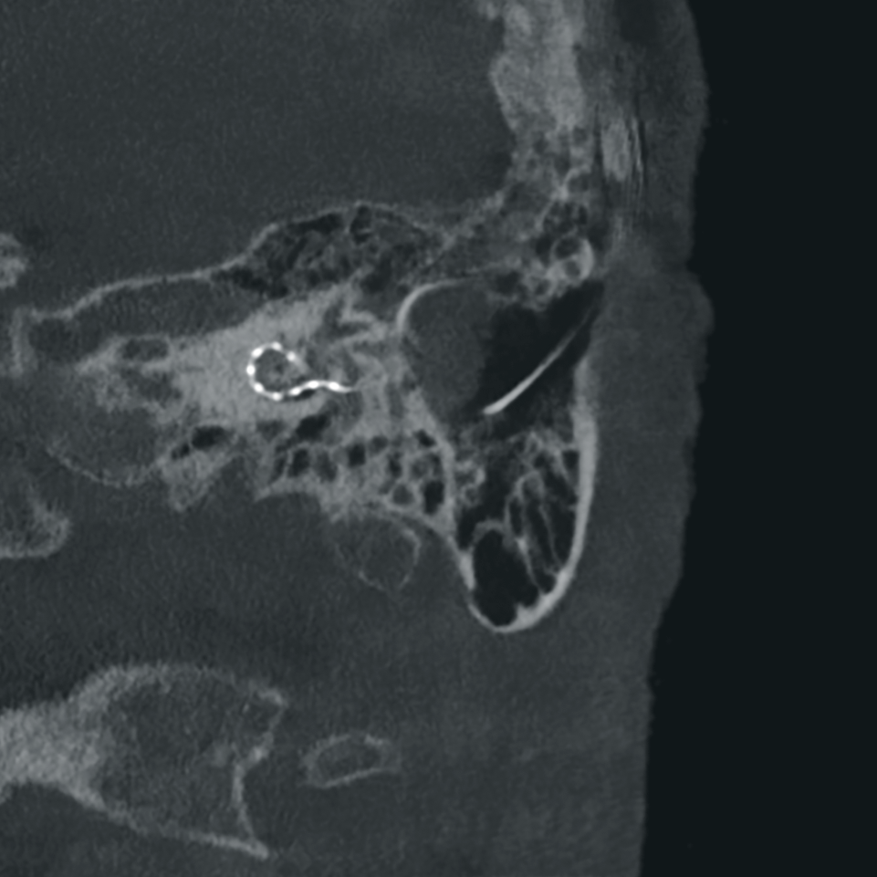 Cochlea-Implantation und HNO-Chirurgie