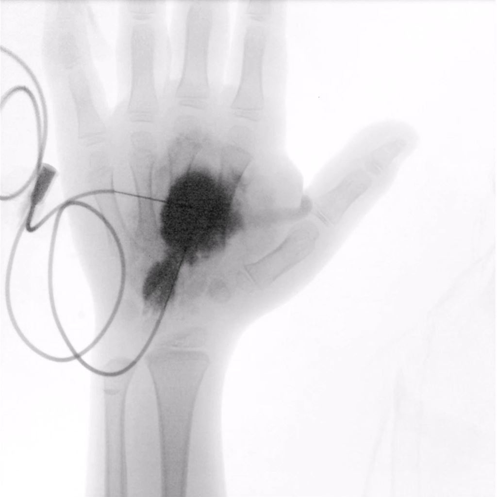 Pediatric hemangioma case