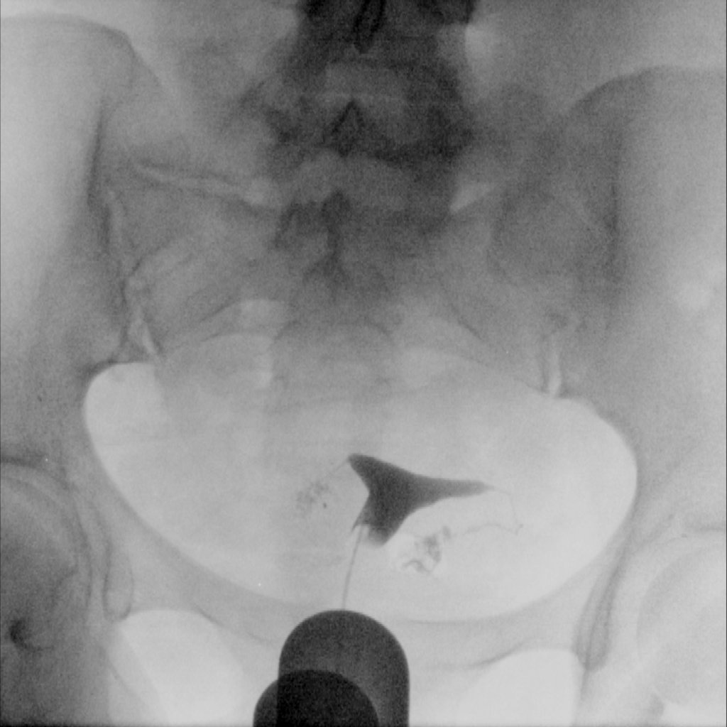 Low-dose fallopian tube angiography