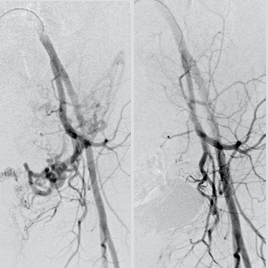 Angiography of the internal iliac artery