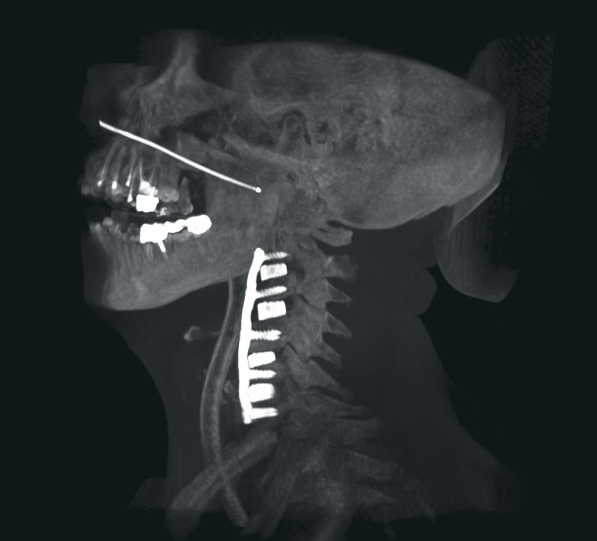 Ziehm Vision RFD 3D