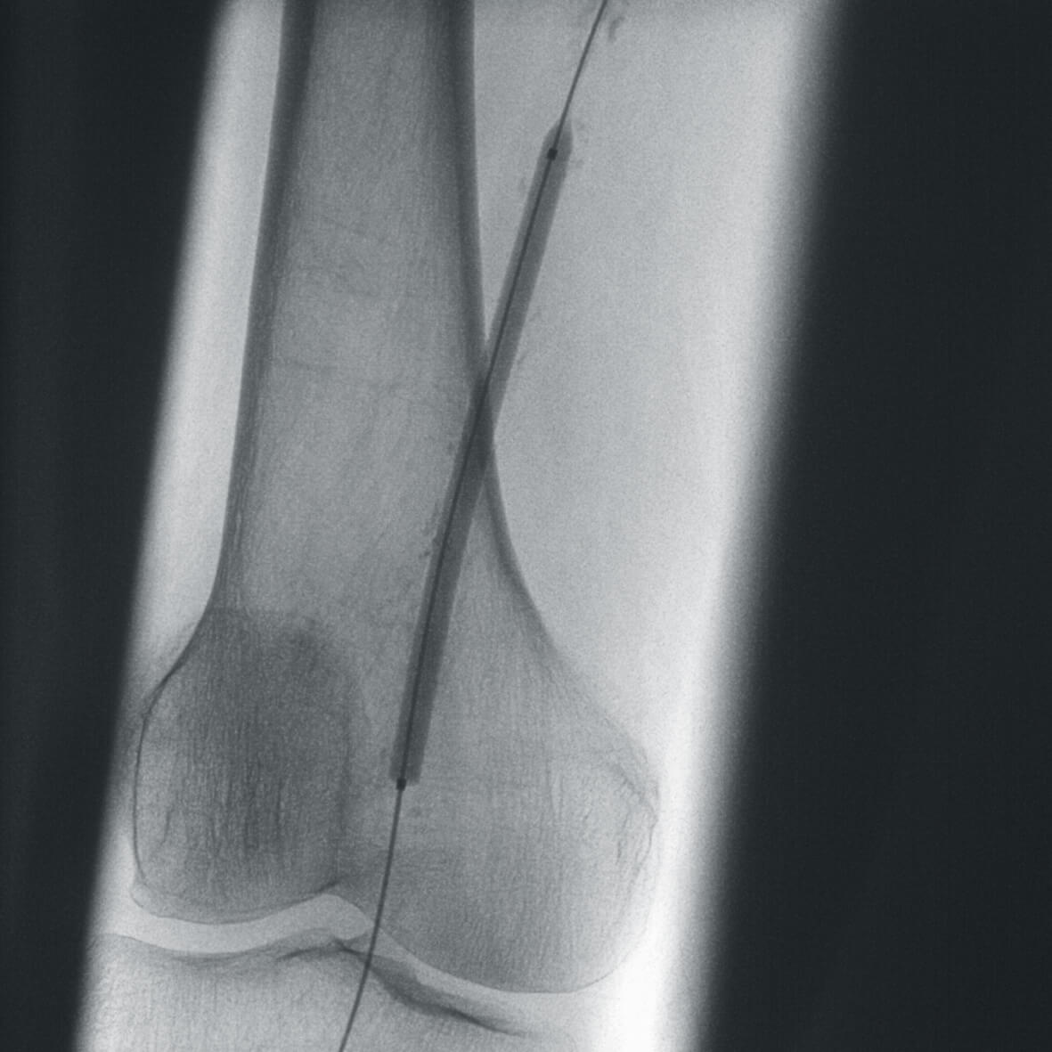 Vascular surgery