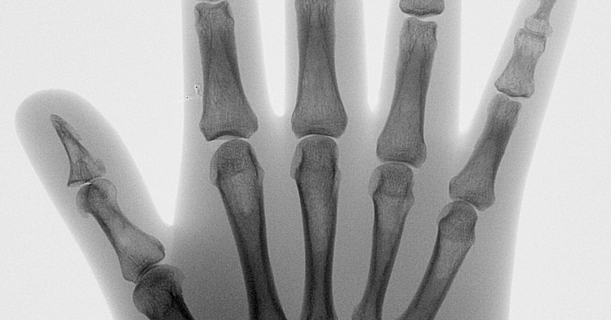 Hand and Foot surgery - Ziehm Imaging | EN
