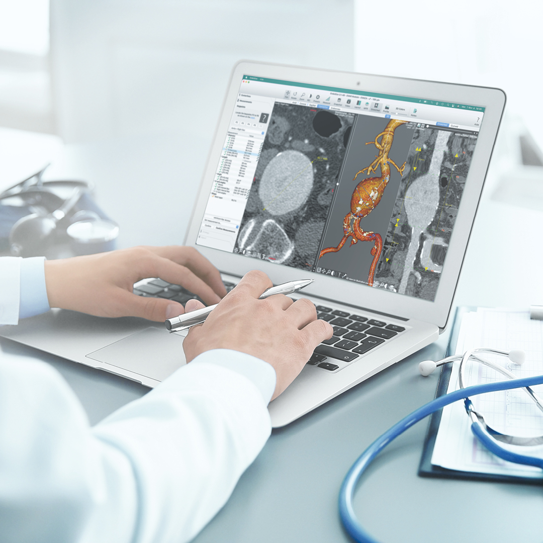 Planejamento de casos endovasculares com Therenva EndoSize