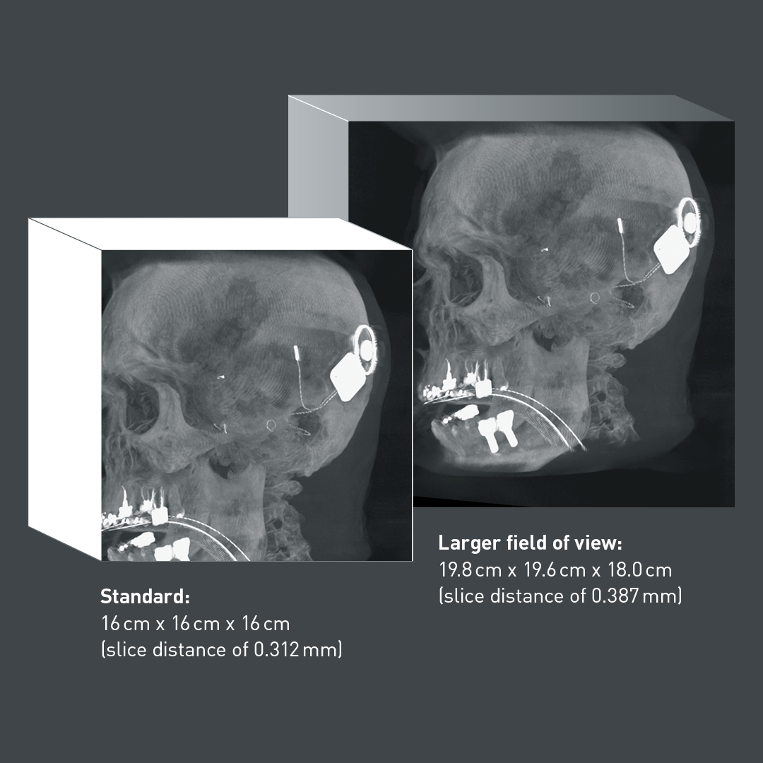 Enhanced Screw Visualization (ESV)